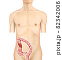 イラスト素材：下行結腸がん003（リアル） 82342006