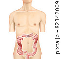 イラスト素材：横行結腸がん002（リアル） 82342009