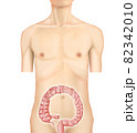イラスト素材：横行結腸がん003（リアル） 82342010