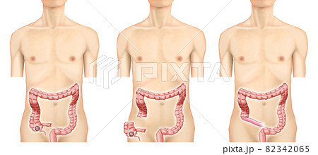 イラスト素材:盲腸がん004(リアル) イラスト素材:盲腸がん004(リアル) 82342065