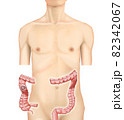 イラスト素材：右結腸がん002（リアル） 82342067