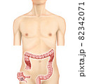 イラスト素材：盲腸がん002（リアル） 82342071