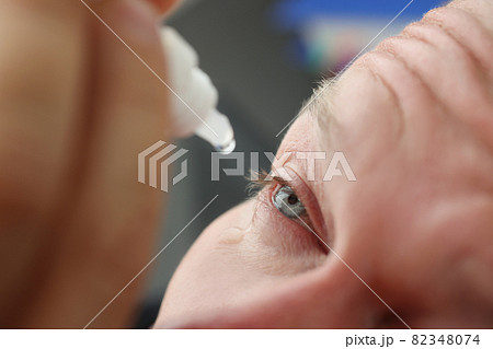 Man with skin allergy digs medical drops into eye Man with skin allergy digs medical drops into eye 82348074