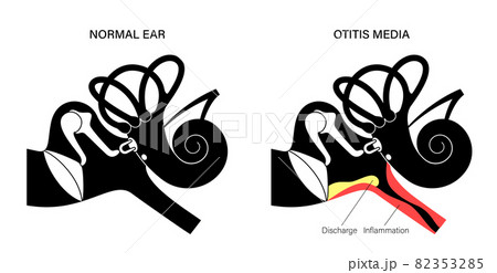 otitis media disease otitis media disease 82353285