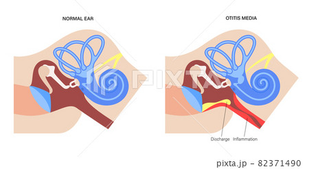 otitis media disease otitis media disease 82371490
