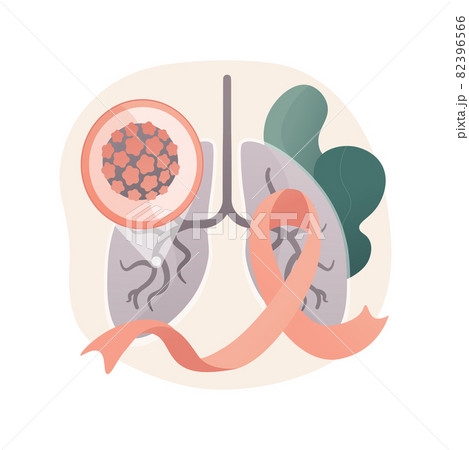 Lung cancer abstract concept vector illustration. Lung cancer abstract concept vector illustration. 82396566