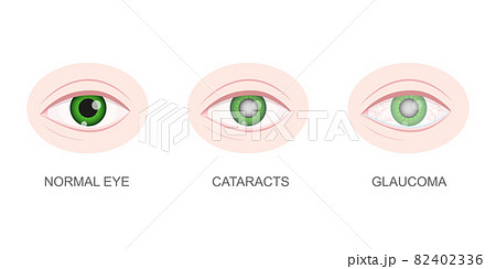 Healthy, cataract and glaucoma eye closeup view. Eyeball with normal and unhealthy lens. Aging visual problems concept. Anatomically detailed human organ of vision. Vector cartoon illustration 82402336