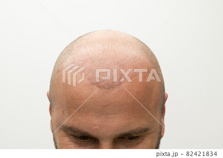 man after hair implant therapy 82421834