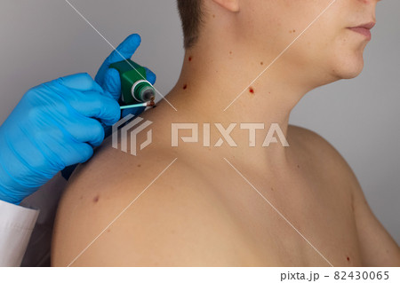 Close-up of the wound that remained after excision of the nevus. Removal and treatment of benign skin lesions. Surgery. Doctor and patient in one shot. Skin disease treatment and surgical care concept Close-up of the wound that remained after excision of the nevus. Removal and treatment of benign skin lesions. Surgery. Doctor and patient in one shot. Skin disease treatment and surgical care concept 82430065