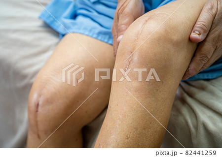 Asian senior or elderly old lady woman patient show her scars surgical total knee joint replacement Suture wound surgery arthroplasty on bed in nursing hospital ward, healthy strong medical concept. Asian senior or elderly old lady woman patient show her scars surgical total knee joint replacement Suture wound surgery arthroplasty on bed in nursing hospital ward, healthy strong medical concept. 82441259