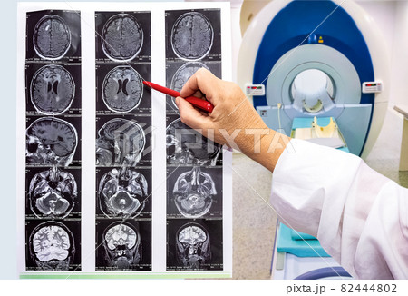 magnetic resonance image or MRI of the brain 82444802