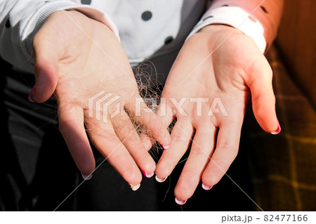 Female hand holding lost hair. Alopecia hair loss treatment concept, hair fall everyday serious problem. Solutions 82477166