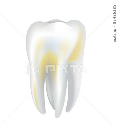 Illnessed human tooth. Dental medical vector icon. Need dental care for stained teeth or tooth caries. Oral teeth restoration Illnessed human tooth. Dental medical vector icon. Need dental care for stained teeth or tooth caries. Oral teeth restoration 82486385