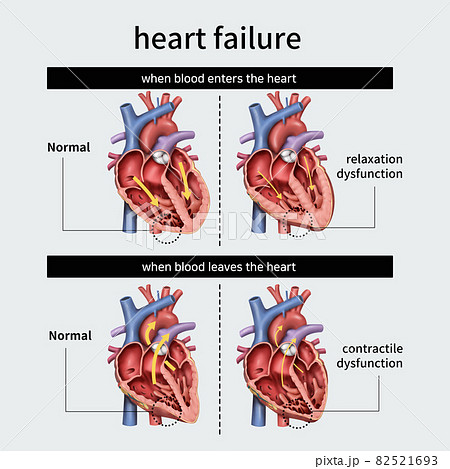 心不全 心臓 疾患 82521693