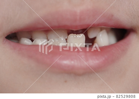 歯が抜けた 歯が抜けた 82529808