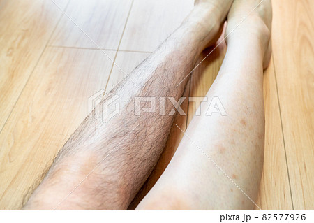 足の毛を剃った男性の写真。剃る前と剃った後の写真。 82577926