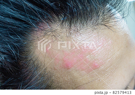 アトピー・皮膚病の写真。おでこにできた炎症の写真。 アトピー・皮膚病の写真。おでこにできた炎症の写真。 82579413