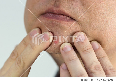 A large ripe pimple on a man's face, close-up A large ripe pimple on a man's face, close-up 82582920