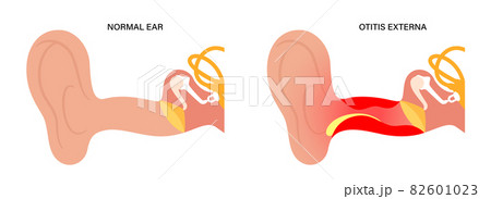 Swimmers ear otitis 82601023