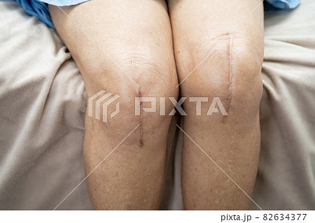 Asian senior or elderly old lady woman patient show her scars surgical total knee joint replacement Suture wound surgery arthroplasty on bed in nursing hospital ward, healthy strong medical concept. Asian senior or elderly old lady woman patient show her scars surgical total knee joint replacement Suture wound surgery arthroplasty on bed in nursing hospital ward, healthy strong medical concept. 82634377