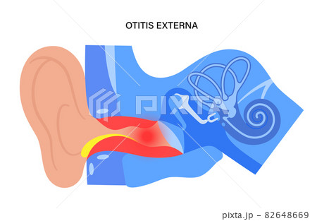Swimmers ear otitis Swimmers ear otitis 82648669