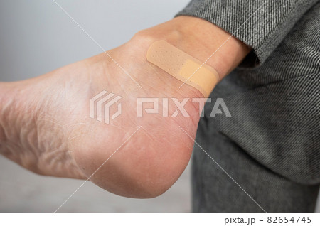 A woman seals a corn on her leg with a plaster. The girl rubbed her leg with uncomfortable shoes. 82654745