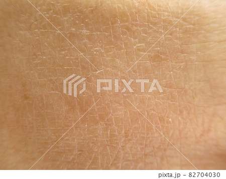 荒れ気味の肌の表面 荒れ気味の肌の表面 82704030