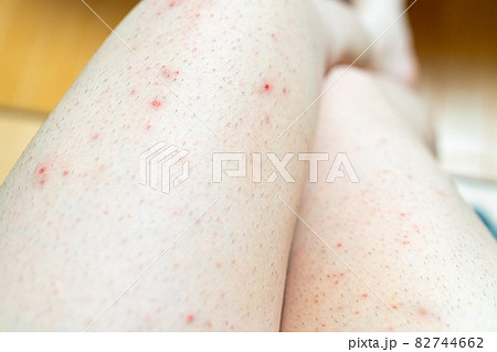足にできた汗疹の写真。皮膚病のイメージ。 足にできた汗疹の写真。皮膚病のイメージ。 82744662