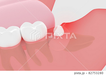 部分的に露出している親知らずの3Dレンダリング 部分的に露出している親知らずの3Dレンダリング 82753280