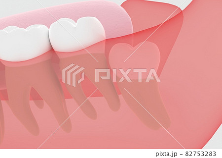 歯茎に埋まっている親知らずの3Dレンダリング 歯茎に埋まっている親知らずの3Dレンダリング 82753283