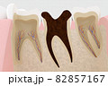 虫歯ができた歯の断面の3Dレンダリング 82857167