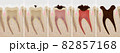 虫歯の進行度の断面の3Dレンダリング 82857168