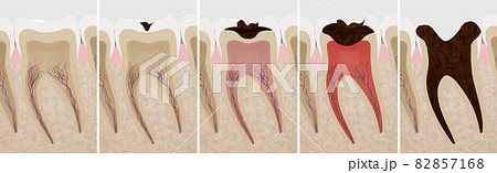 虫歯の進行度の断面の3Dレンダリング 82857168