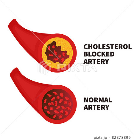 Normal and narrowed artery cross section illustration 82878899