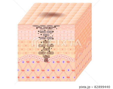 肌断面（しみ） 82899440