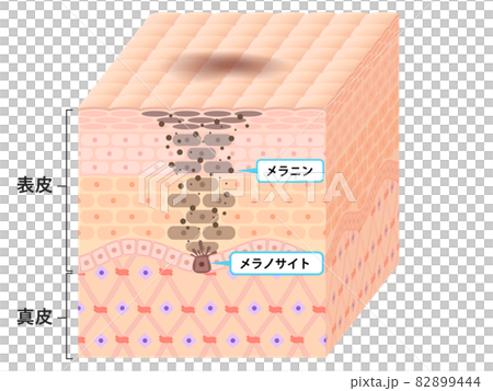 肌断面（しみ） 82899444