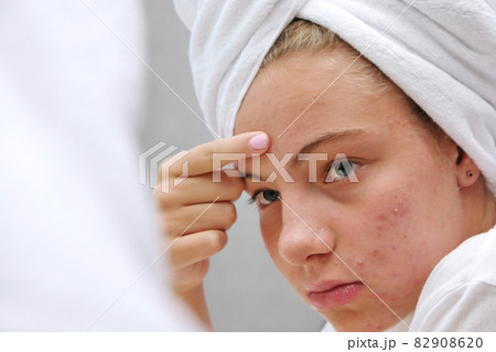 A sad teenage girl is looking at the pimples on her face in the mirror. Problematic skin. Acne. 82908620