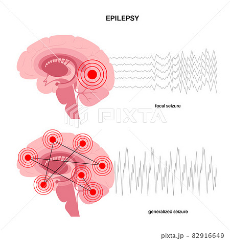 epilepsy seizure concept 82916649