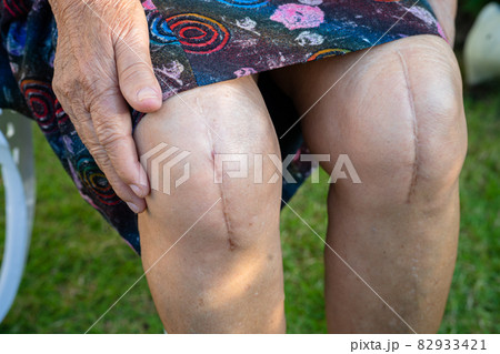 Asian senior lady old woman patient show her scars surgical total knee joint replacement. 82933421