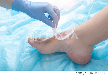 Doctor cosmetologist removes wax strip from patient's leg for hair removal. Epilation concept for smooth skin, blue background. Sensitive skin 82946385
