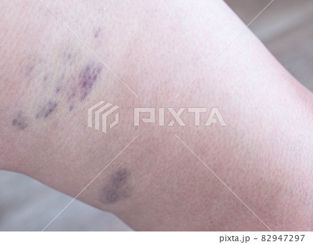 Bruises and thrombosis on the legs of a woman. Phlebeurysm, close-up, chronic Bruises and thrombosis on the legs of a woman. Phlebeurysm, close-up, chronic 82947297