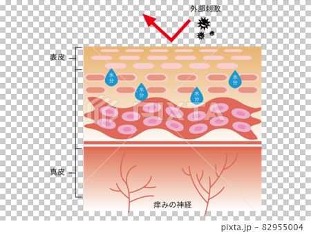 Atopic dermatitis 82955004