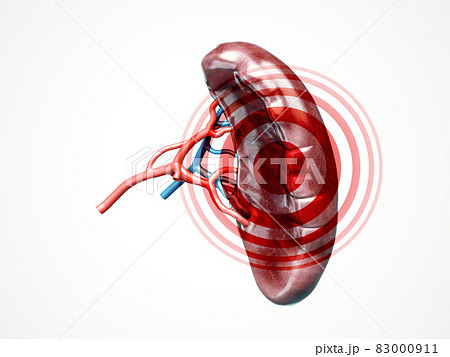 Anatomically accurate 3d illustration of human internal organ spleen with disease Anatomically accurate 3d illustration of human internal organ spleen with disease 83000911