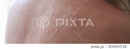 Woman injured back with rash and red sun spots 83094536
