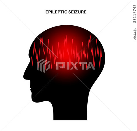 epilepsy seizure concept 83117742