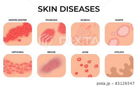 Skin disease. Different diseases, epidermis surface with eczema. Dermatology, allergy symptoms. Human body psoriasis, medical recent vector set 83126547