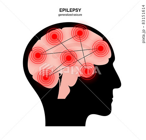 epilepsy seizure concept 83151614