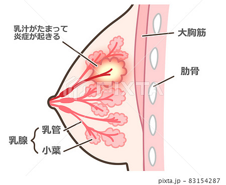 乳腺炎のイラスト　説明付 83154287