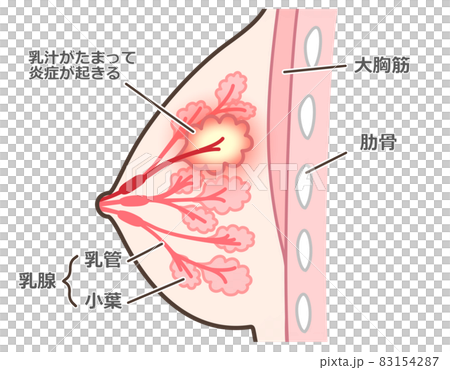 乳腺炎のイラスト　説明付 83154287