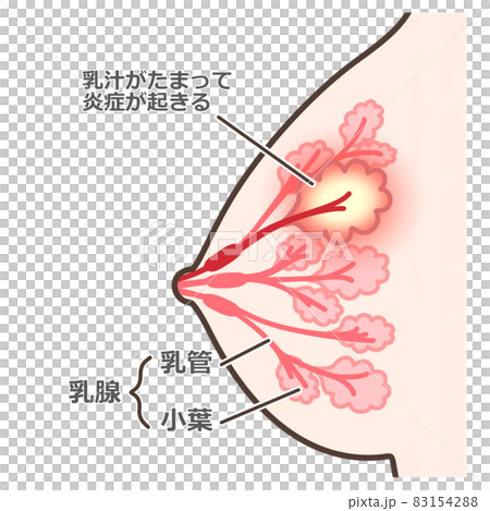 乳腺炎のイラスト　説明付 83154288
